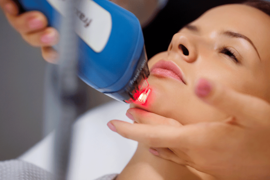 laser facial skin resurfacing