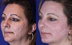 Fractional Laser Resurfacing Before and After Photos