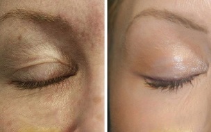 laser correction to fix skin problems