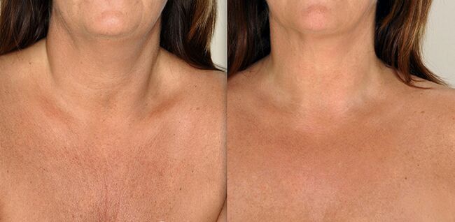 Cleavage area before and after rejuvenation procedures. 