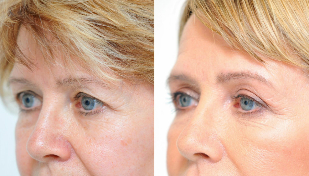 blepharoplasty-before-and-after
