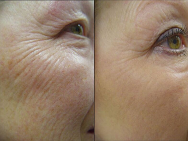 Before and after the laser resurfacing procedure a significant reduction in wrinkles