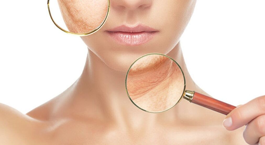 Wrinkles can be effectively removed with laser treatment. 