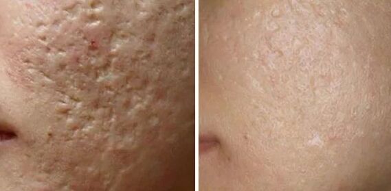 Scars laser