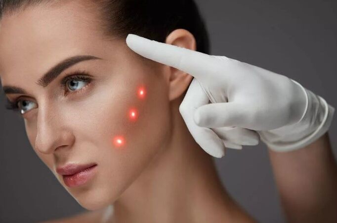 Skin laser rejuvenation
